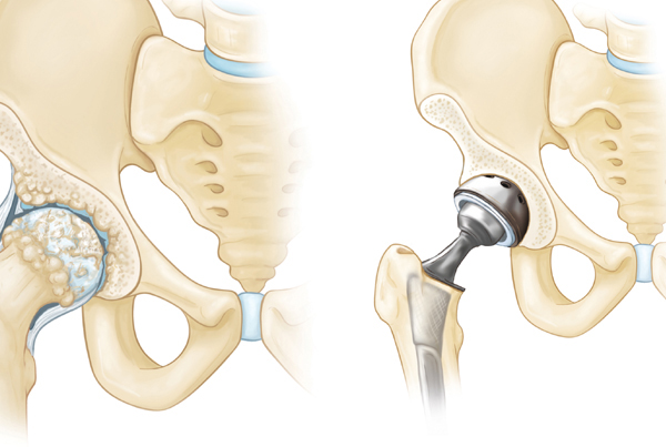 Hip Replacement Surgery